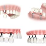 Phục hình trên Implant