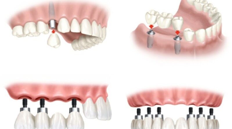 Phục hình trên Implant