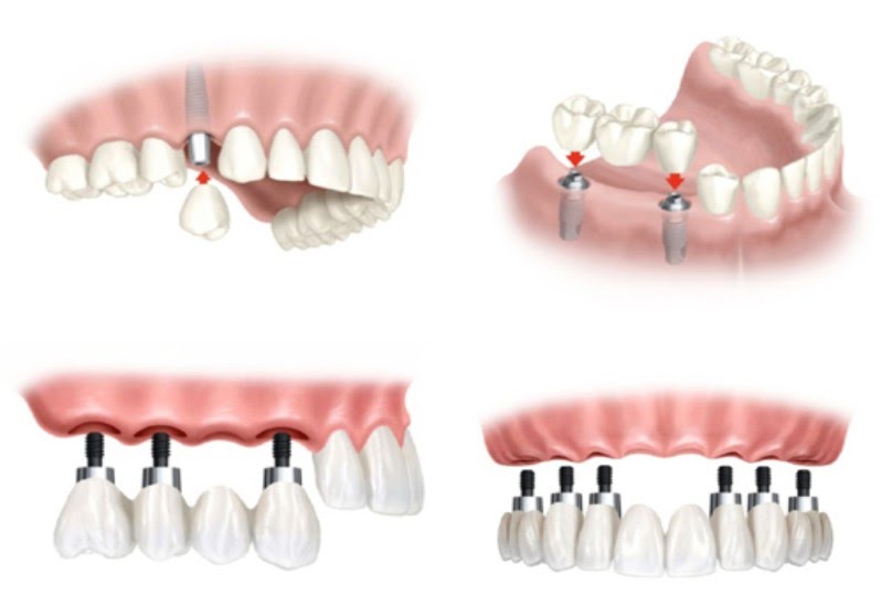 Phục hình trên Implant