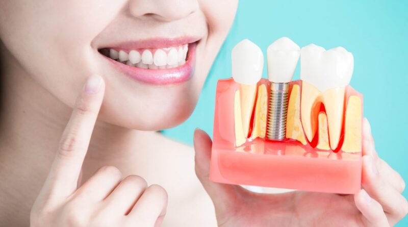 Quy trình trồng răng implant