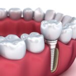 trụ Implant Paltop Mỹ