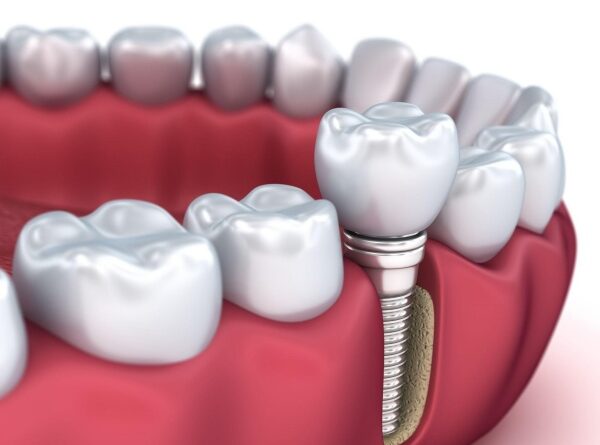 trụ Implant Paltop Mỹ