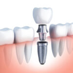 Trồng Implant có dung được vĩnh viễn không?