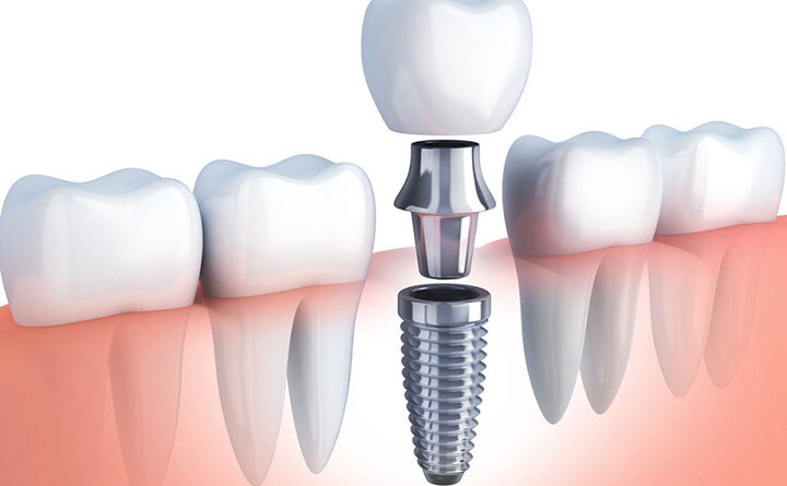 Trồng Implant có dung được vĩnh viễn không?