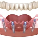 Trồng răng Implant toàn hàm