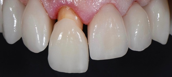 Giải đáp mài răng bọc sứ có ảnh hưởng gì không