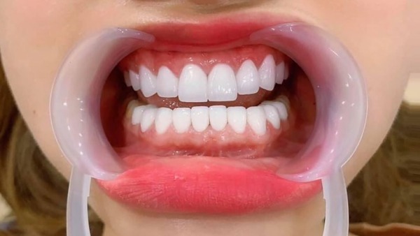 Lưu ý trước và sau khi mài răng bọc sứ
