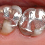 Vật liệu trám răng glass ionomer