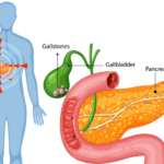 Phương pháp điều trị bệnh sỏi mật