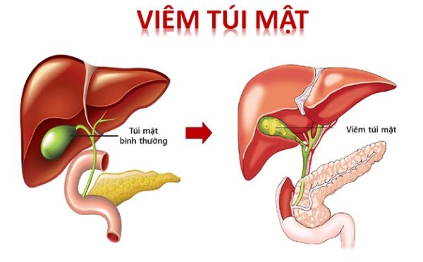 Biến chứng của bệnh sỏi túi mật