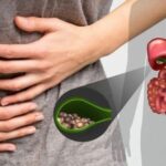 Sỏi túi mật lâu ngày gây rối loạn tiêu hóa