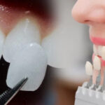 Những trường hợp nên bọc răng sứ thẩm mỹ