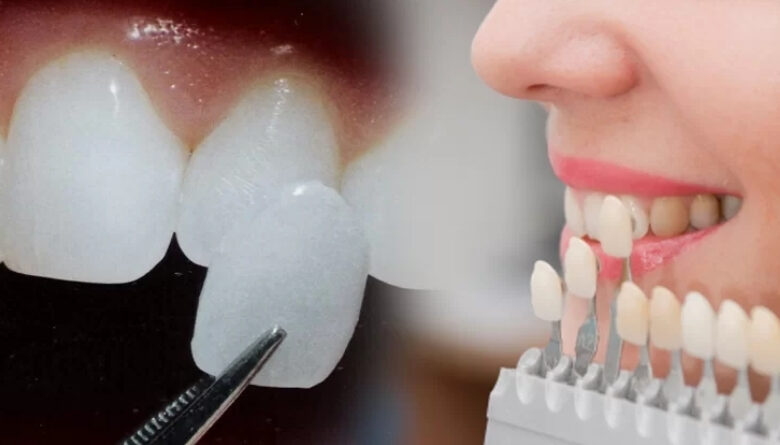 Những trường hợp nên bọc răng sứ thẩm mỹ