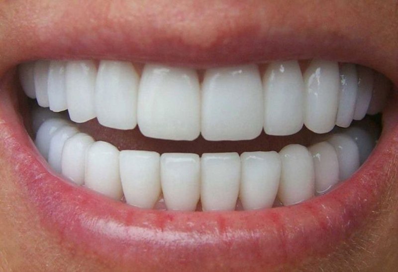Những lý do bạn nên bọc răng sứ nguyên hàm
