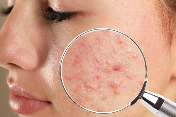 Hướng dẫn giảm sưng đỏ do mụn viêm