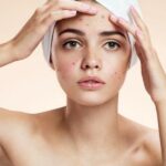 Thói quen gây sẹo mụn nào cần thay đổi để bảo vệ da