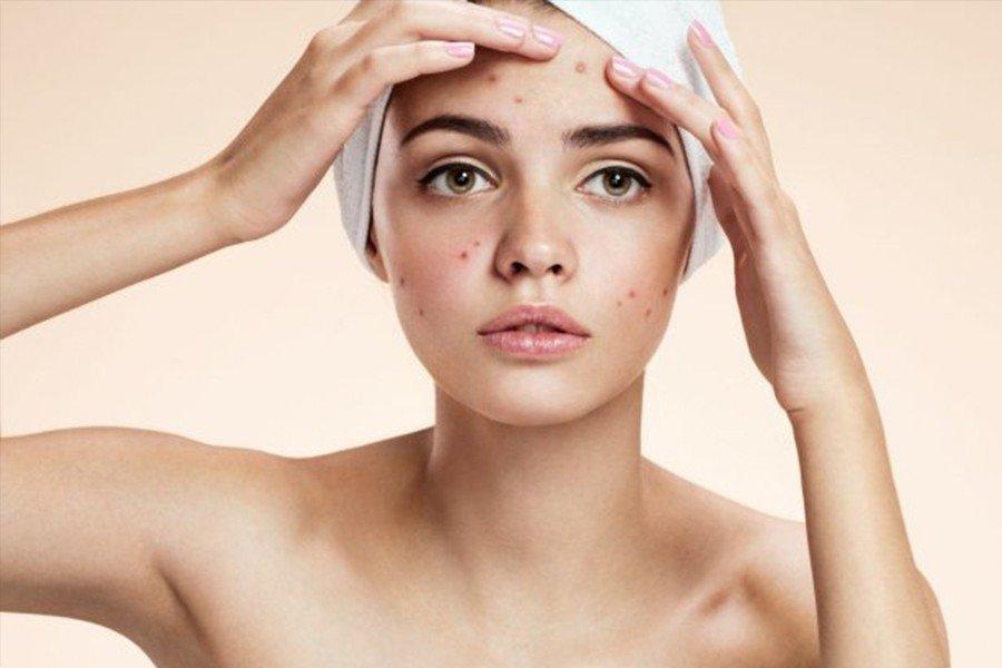 Thói quen gây sẹo mụn nào cần thay đổi để bảo vệ da